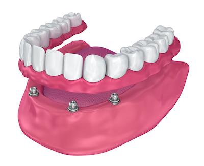 Implant retained dentures 