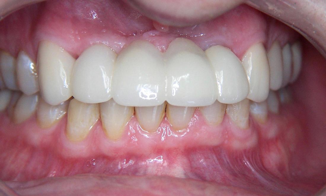 Dental Implant Restorations in Gaithersburg MD