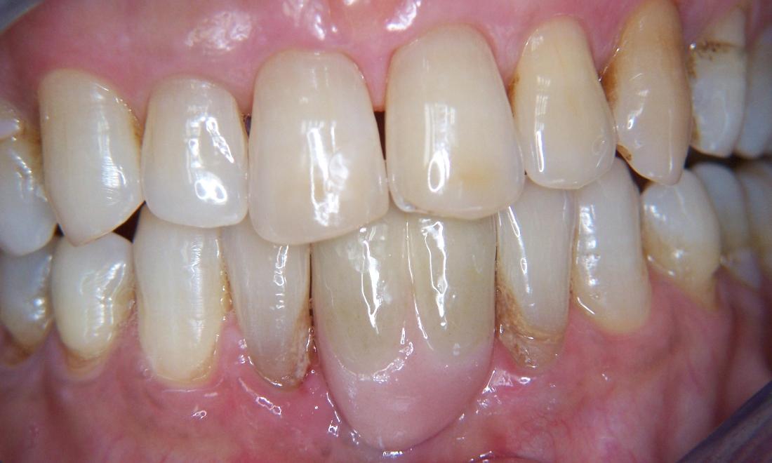 Adult Orthodontics in Gaithersburg MD