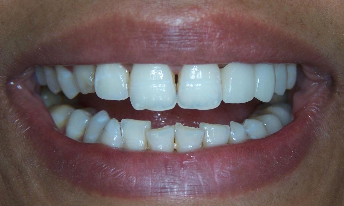 Missing Tooth Replacement in Gaithersburg MD