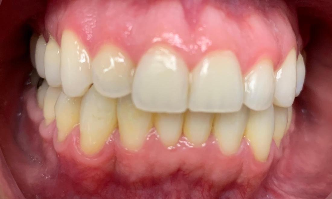 Patient smile after Invisalign
