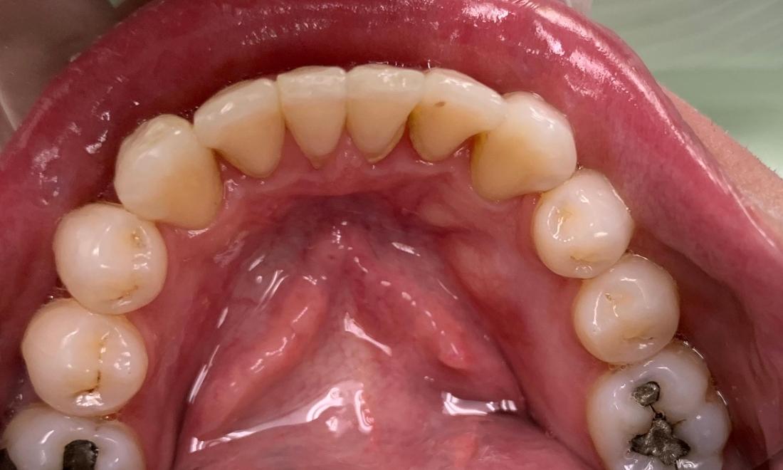 Patient's lower teeth after Invisalign