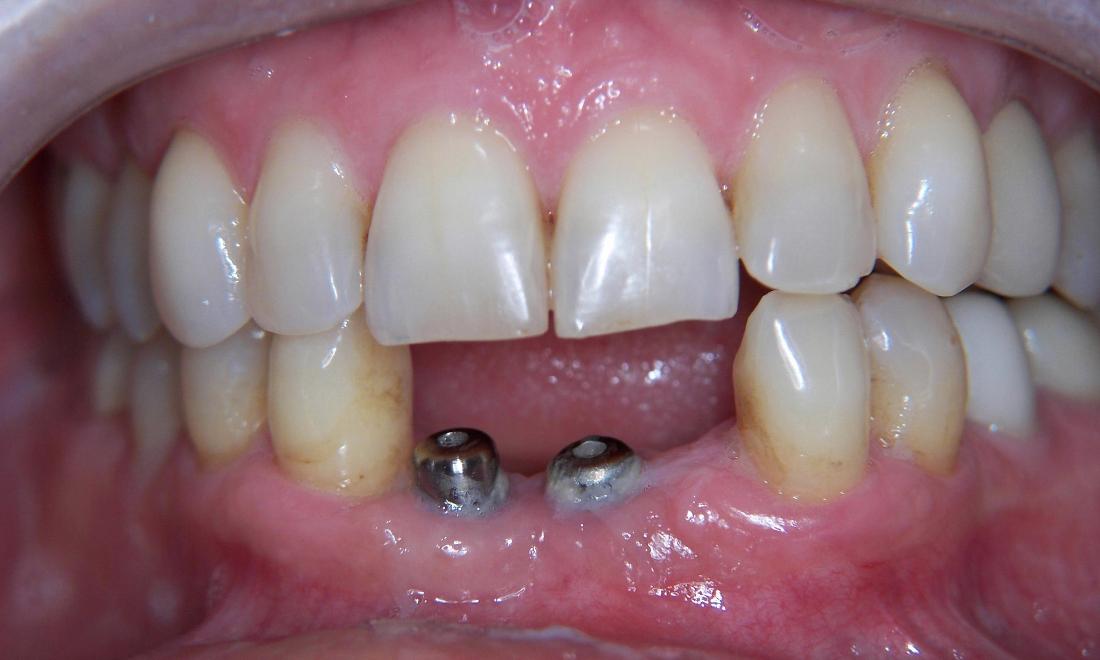 Dental Implants in Gaithersburg MD