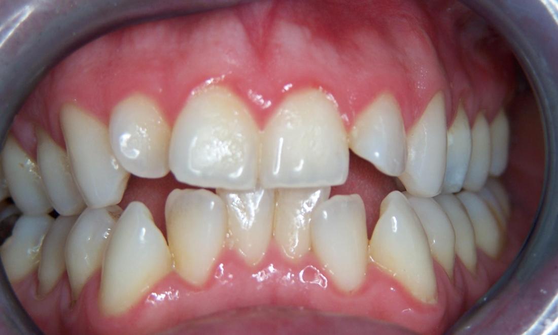 Patient smile before Invisalign