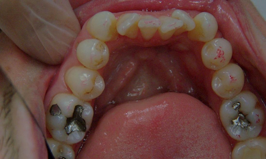 Patient's lower teeth before Invisalign