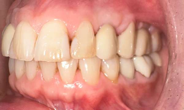 dental implants gaithersburg- After Photo