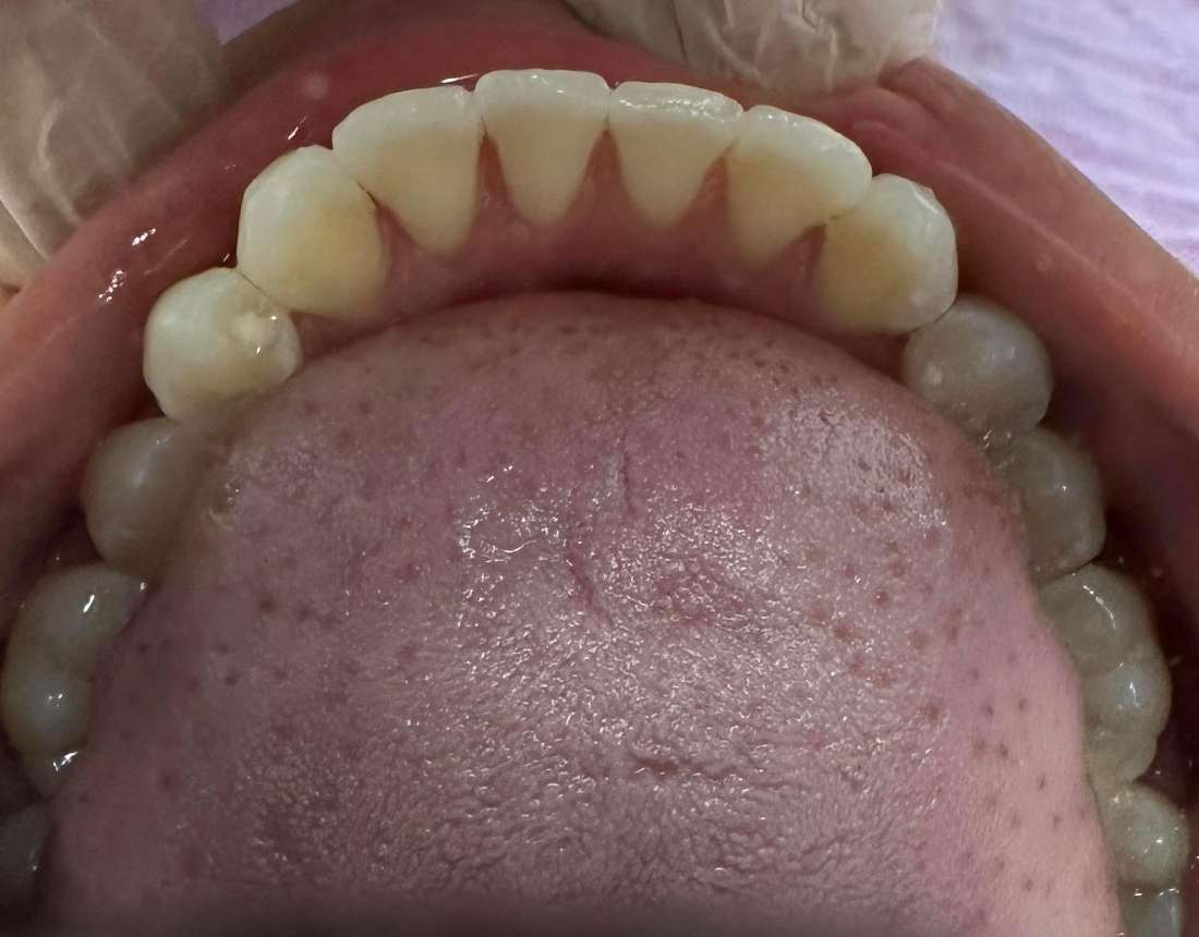 After Invisalign Clear Aligners