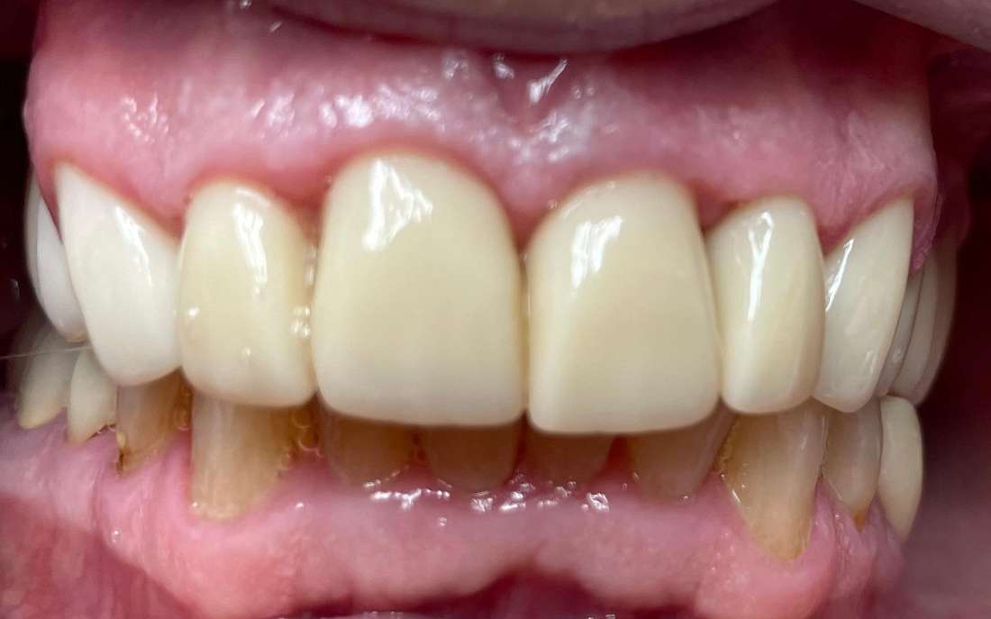 smile restoration after