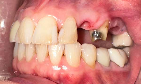 dental implants gaithersburg- Before Photo