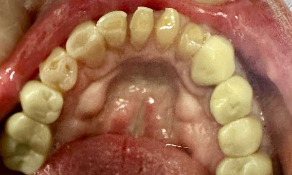 dental crowns gaithersburg- before photo