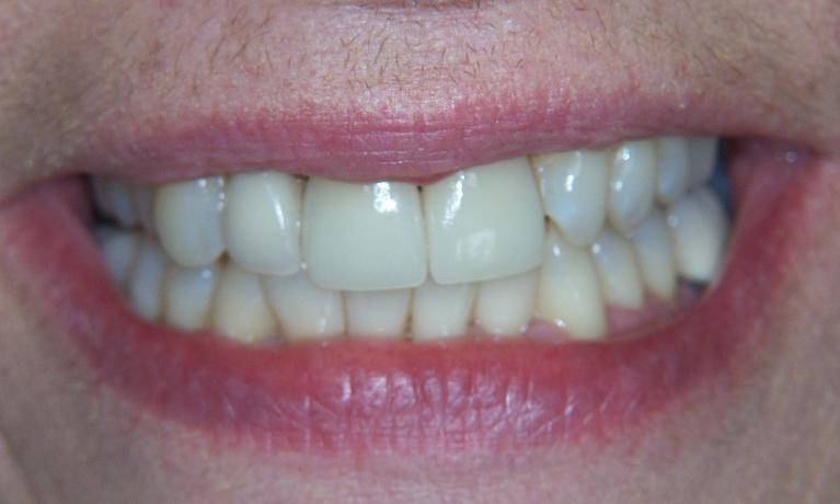 Tooth Restoration in Gaithersburg MD