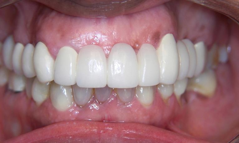 Dental Bridges in Gaithersburg MD
