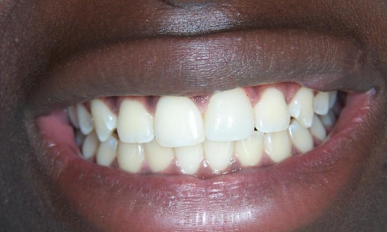 Front Tooth Repair in Gaithersburg MD