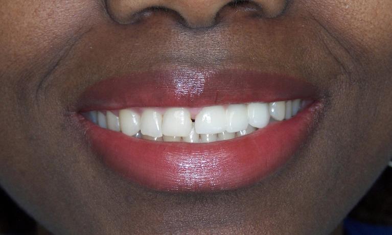 Dental Implant Restorations in Gaithersburg MD