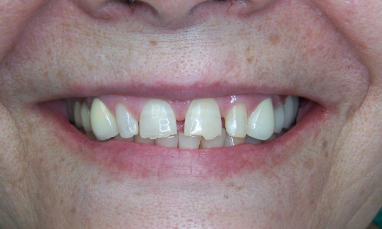Dental Bridge Restorations in Gaithersburg MD