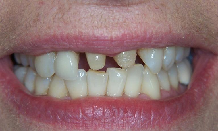 Tooth Restoration in Gaithersburg MD
