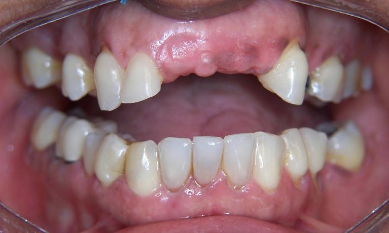 Tooth Replacement in Gaithersburg MD