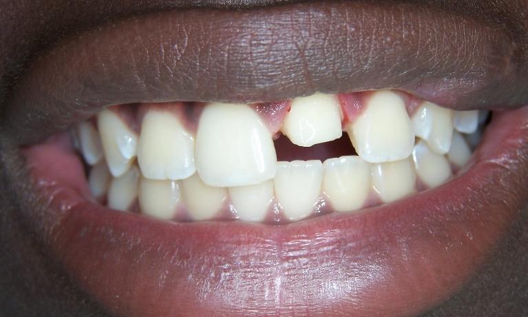Front Tooth Repair in Gaithersburg MD