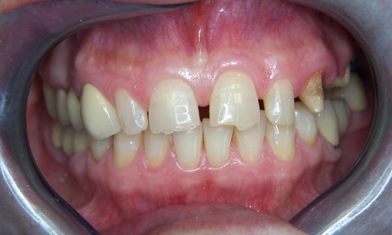 Dental Bridge in Gaithersburg MD