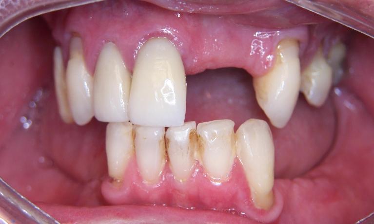 Upper-and-Lower-Partials-in-Gaithersburg-MD-Before-Image