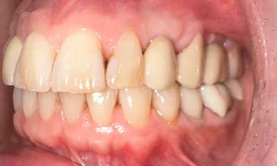 dental implants gaithersburg- After Photo