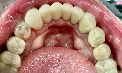 dental crowns gaithersburg- after photo