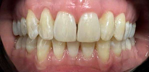 Gaithersburg, MD Invisalign- After Photo