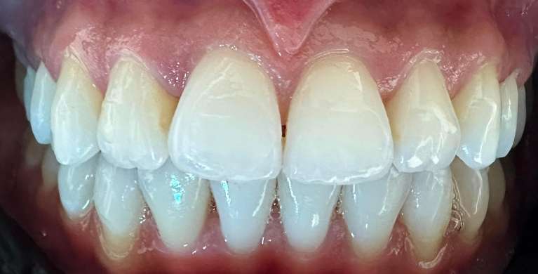 After Invisalign Transformation
