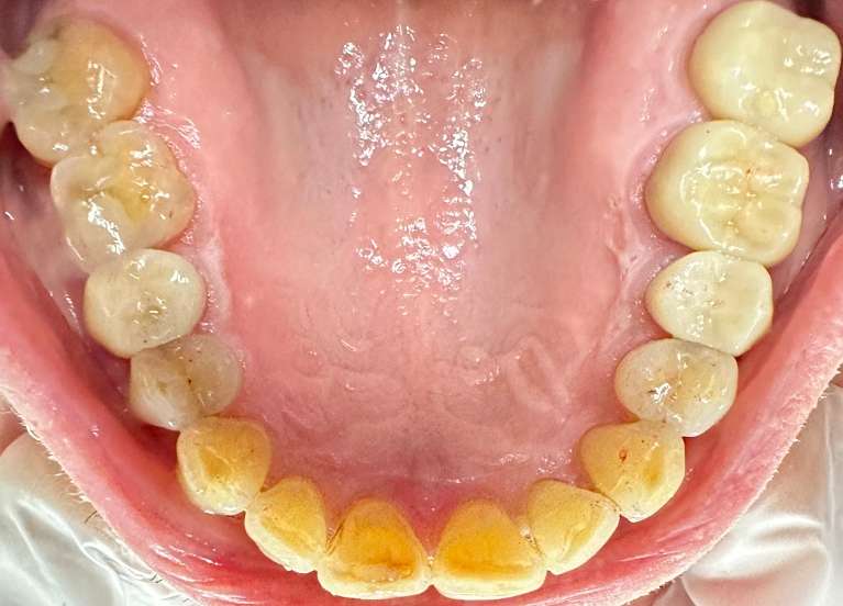 2nd photo after Invisalign of older gentleman teeth