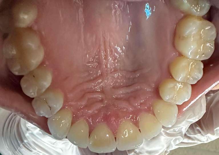 2nd photo after Invisalign Transformation