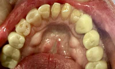 dental crowns gaithersburg- before photo