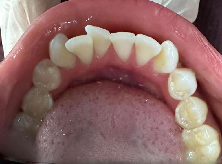 Before Invisalign Clear Aligners