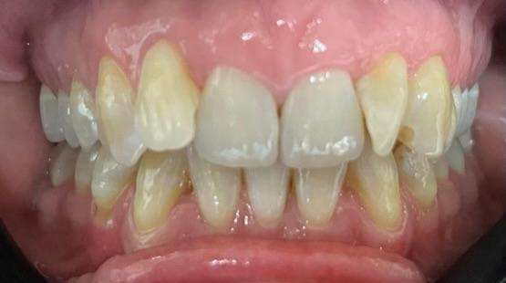 Gaithersburg, MD Invisalign- Before Photo