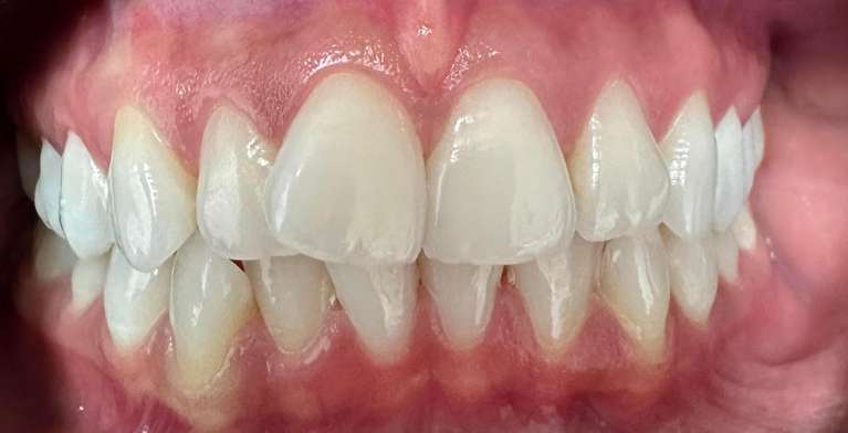Before Invisalign Transformation