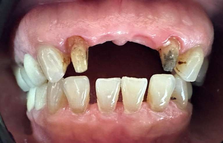Before Prosthesis For Missing Front Teeth