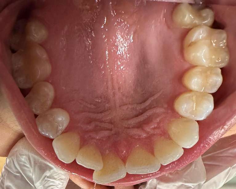 2nd photo before Invisalign Transformation