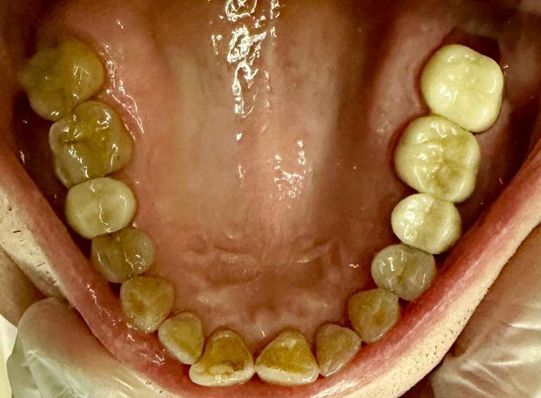 2nd photo before Invisalign of older gentleman teeth