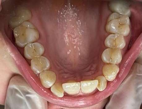 Gaithersburg, MD Invisalign- Before Photo